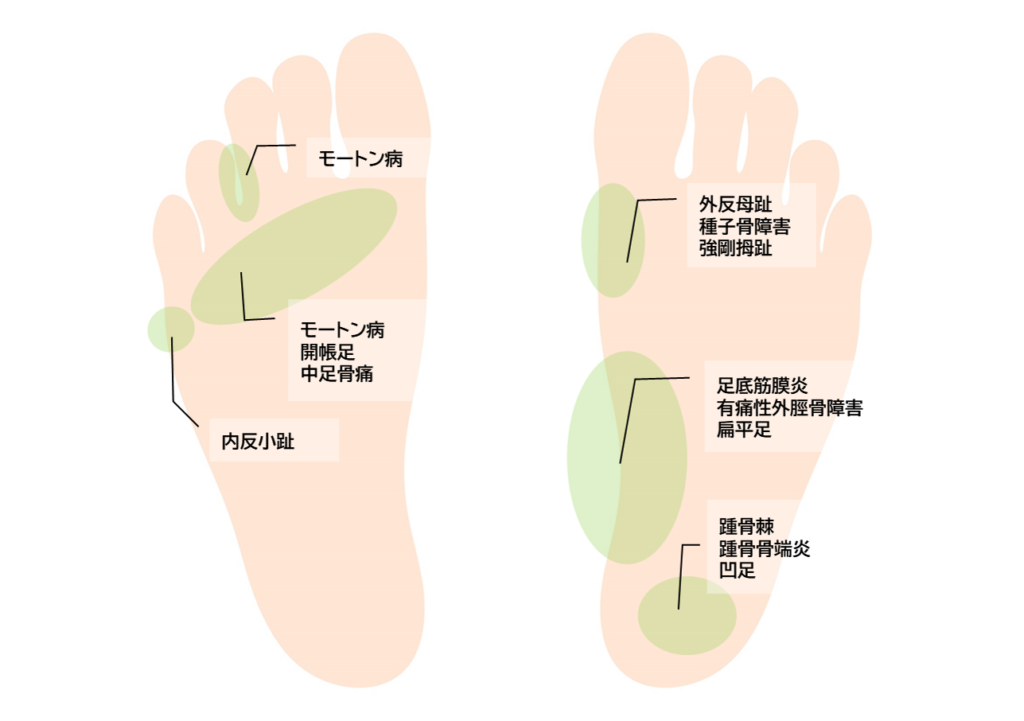 足裏の痛みの原因は？症状や予防に効果的な方法についても解説 