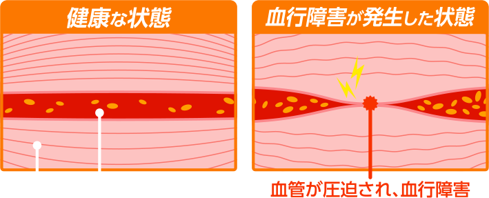 血管が圧迫され、血行障害が発生